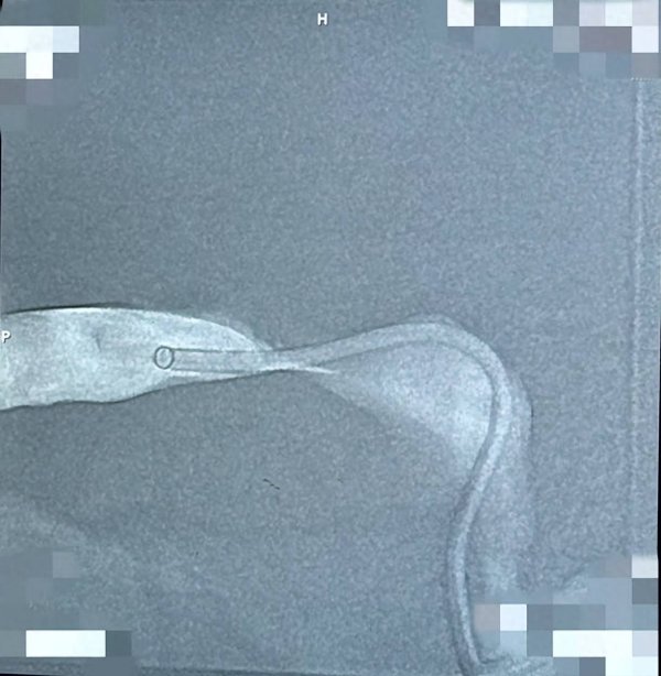 伍洲配资 16岁少年脑部“塞车”，泰康同济紧急植入支架打通生命通道