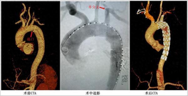 问道管理 湘雅二医院完成首例主动脉弓单分支覆膜支架系统人体植入